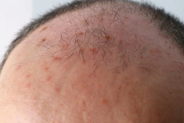 Actinic Keratoses Farnborough 
