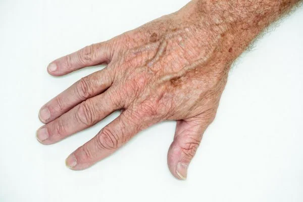 age spot removal Farnborough 