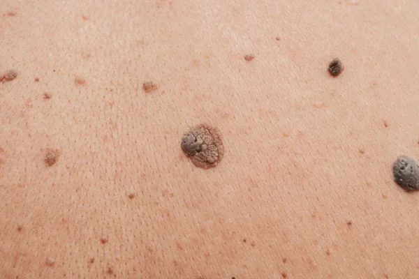 Benign Moles Farnborough 