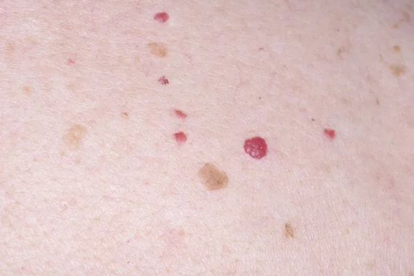 Cherry Angiomas Farnborough 