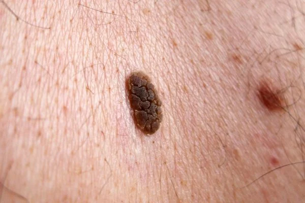 Seborrhoeic Keratoses removal Farnborough 
