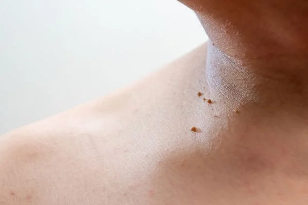 skin tag removal Farnborough 